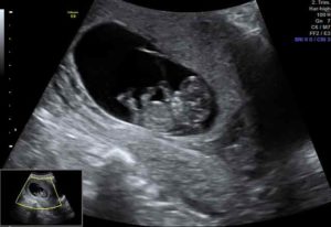 sneak-a-peek-ultrasound-2d
