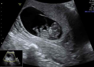 sneak-a-peek-ultrasound-2d