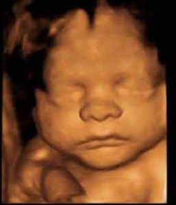 sneak-a-peek-ultrasound-3d