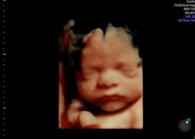 sneak-a-peek-ultrasound-3d