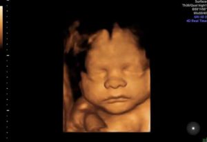 sneak-a-peek-ultrasound-3d