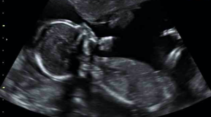 sneak-a-peek-ultrasound